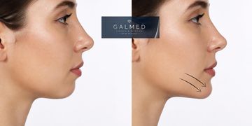 Relleno de mentón con ácido hialurónico | Perfilado facial Relleno de mentón con ácido hialurónico | Perfilado facial