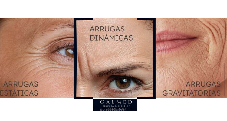 Arrugas dinámicas: qué son y cómo se tratan.