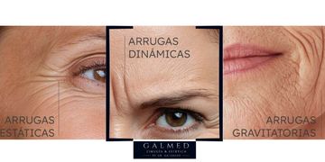 Arrugas dinámicas: qué son y cómo se tratan.