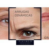 Arrugas dinámicas: qué son y cómo se tratan.