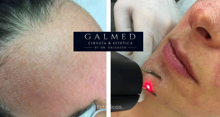 ¿Cómo es realmente la recuperación después del láser CO₂ fraccionado facial?