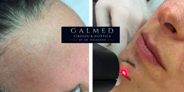 ¿Cómo es realmente la recuperación después del láser CO₂ fraccionado facial? ¿Cómo es realmente la recuperación después del láser CO₂ fraccionado facial?