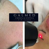 ¿Cómo es realmente la recuperación después del láser CO₂ fraccionado facial?