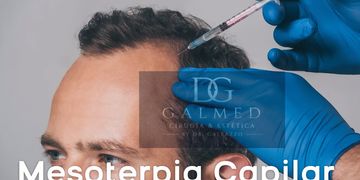 Mesoterapia capilar: qué es, cómo se realiza y cuándo puede estar indicada para la caída del cabello Mesoterapia capilar: qué es, cómo se realiza y cuándo puede estar indicada para la caída del cabello
