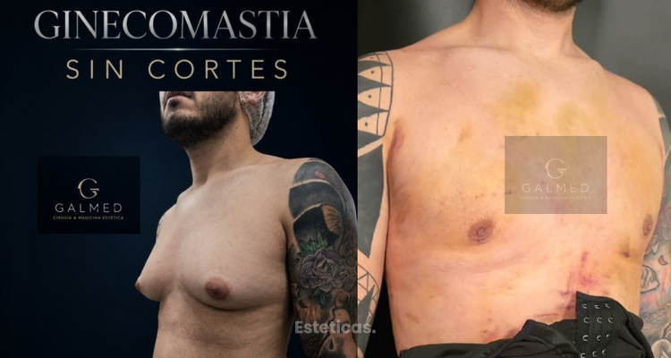 Ginecomastia en hombres: cuándo la cirugía puede ser el momento de recuperar la confianza