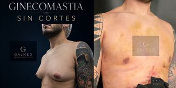 Ginecomastia en hombres: cuándo la cirugía puede ser el momento de recuperar la confianza Ginecomastia en hombres: cuándo la cirugía puede ser el momento de recuperar la confianza