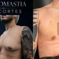 Ginecomastia en hombres: cuándo la cirugía puede ser el momento de recuperar la confianza