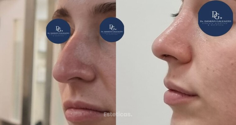 Cinco factores que determinan un resultado natural en una cirugía plástica