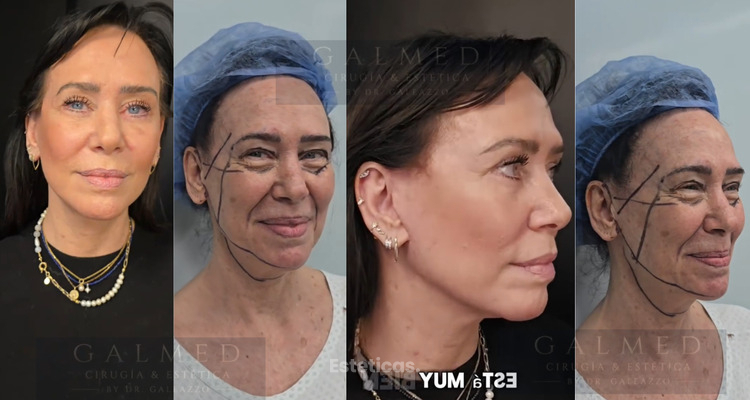 Lifting Facial  | Cirugía Facial