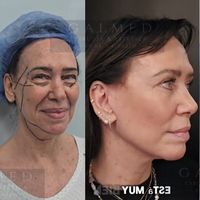 Lifting Facial  | Cirugía Facial