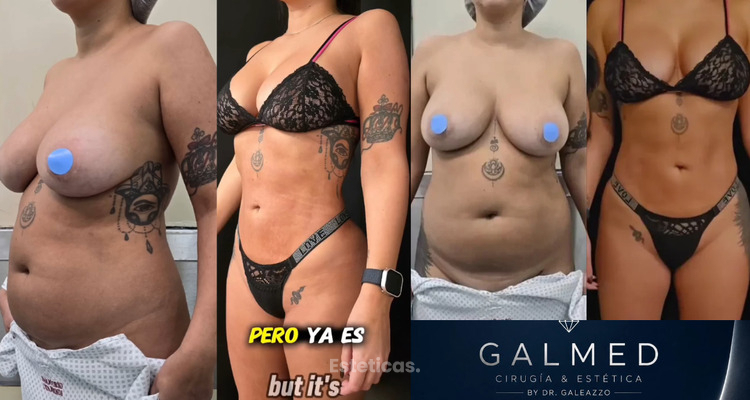 Lipoescultura sin corte: cómo logramos evitar una dermolipectomía y observar un cambio a los dos meses