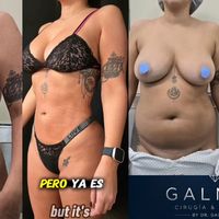 Lipoescultura sin corte: cómo logramos evitar una dermolipectomía y observar un cambio a los dos meses