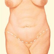 abdominoplastia1.jpg