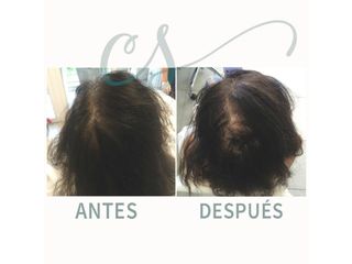 Mesoterapia - antes y después - dra. carolina salvador