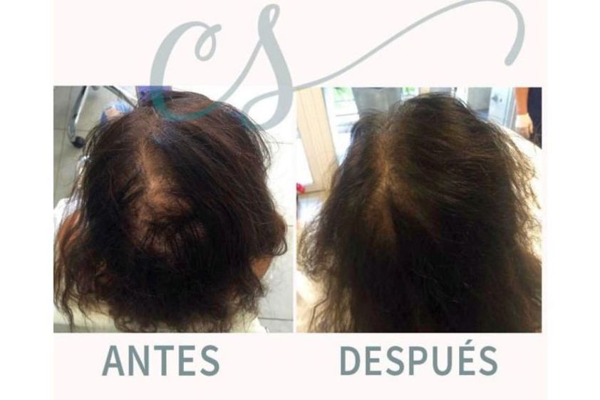 Mesoterapia antes y después - 643670
