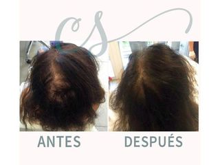 Mesoterapia - antes y después - dra. carolina salvador