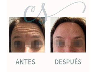 Entrecejo - antes y después - dra. carolina salvador