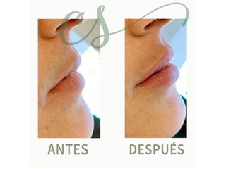 Relleno de labios - antes y después - dra. carolina salvador