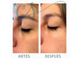 Blefaroplastia - antes y después - dra. carolina salvador