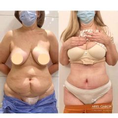 Liposucción - Dr. Ariel Ignacio García