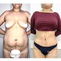 Liposucción - Dr. Ariel Ignacio García