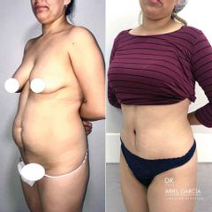 Liposucción - Dr. Ariel Ignacio García