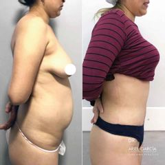 Liposucción - Dr. Ariel Ignacio García
