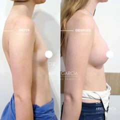 Aumento mamas - Dr. Ariel Ignacio García