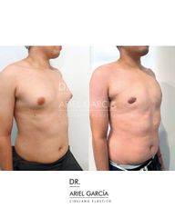 Ginecomastia - Dr. Ariel Ignacio García