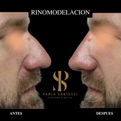 Rinomodelación  - Dr. Pablo Santucci