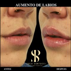 Relleno de labios - Dr. Pablo Santucci