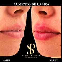 Relleno de labios - Dr. Pablo Santucci