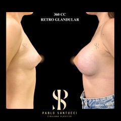 Aumento Mamas -Dr. Pablo Santucci