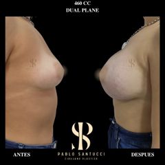 Aumento Mamas -Dr. Pablo Santucci