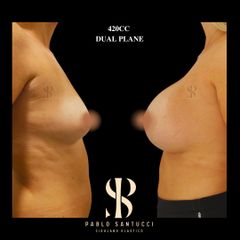 1Aumento Mamas -Dr. Pablo Santucci
