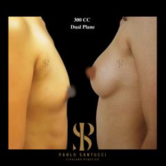 Aumento Mamas -Dr. Pablo Santucci