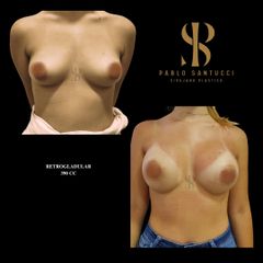 Aumento Mamas -Dr. Pablo Santucci