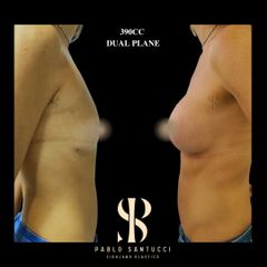 Aumento Mamas -Dr. Pablo Santucci