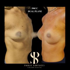 Aumento Mamas -Dr. Pablo Santucci