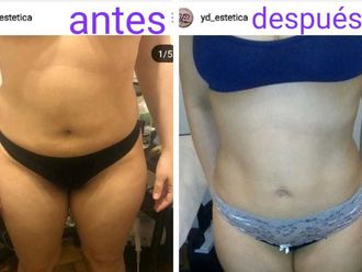 Drenaje linfático antes y después - 631198