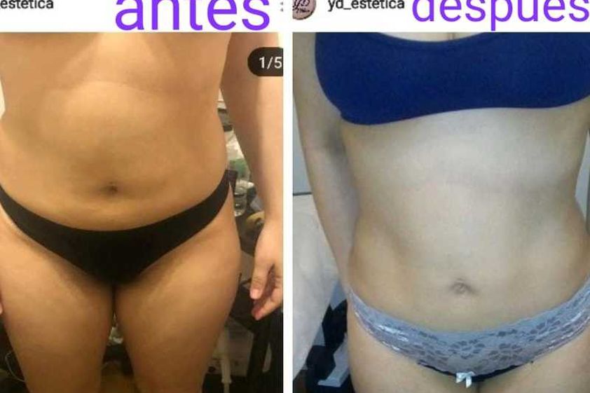 Drenaje linfático antes y después - 631198