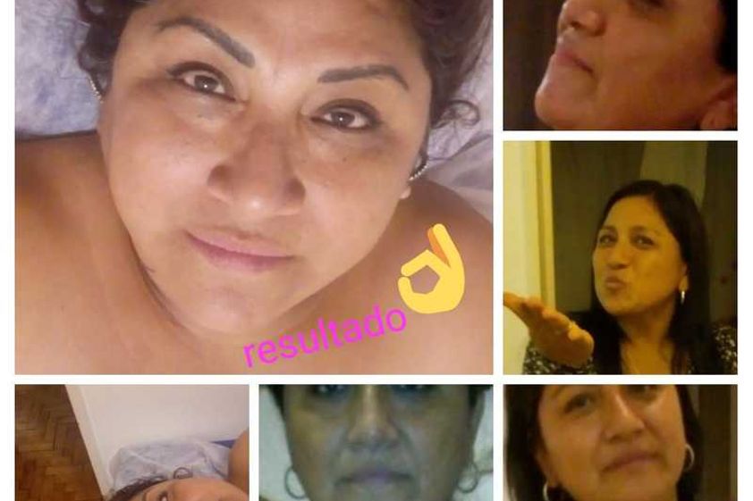 Radiofrecuencia antes y después - 631430