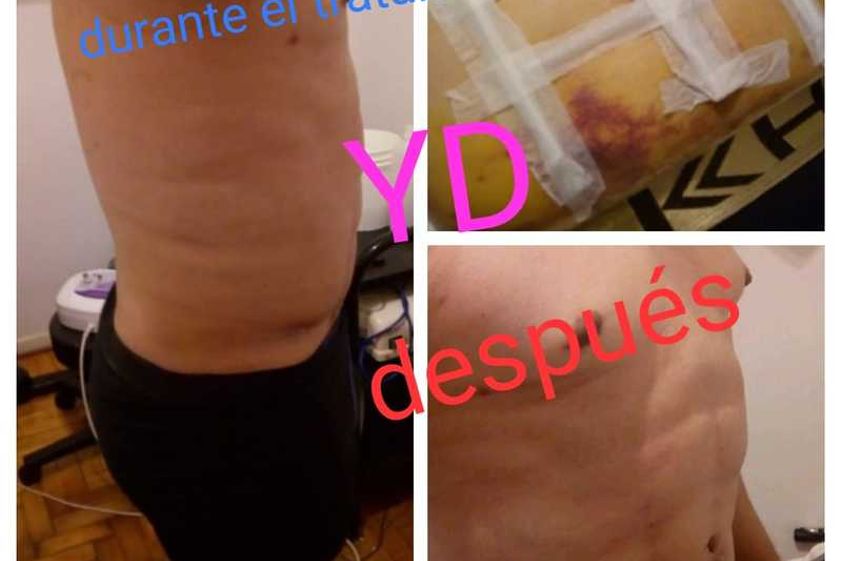 Drenaje linfático antes y después - 631431