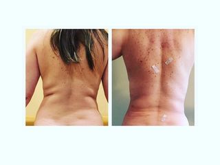 Lipoescultura