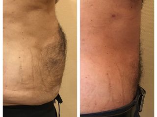Abdominoplastia