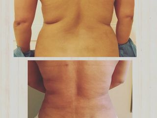 Lipoaspiracion