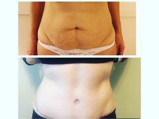 Abdominoplastia