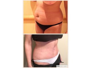 Abdominoplastia