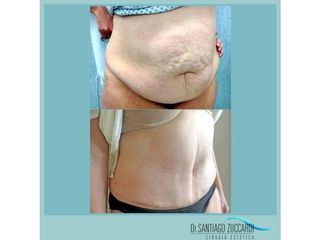 Abdominoplastia