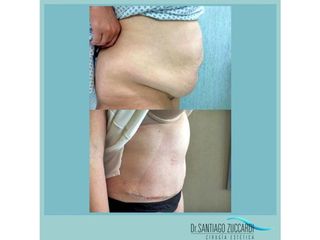 Abdominoplastia